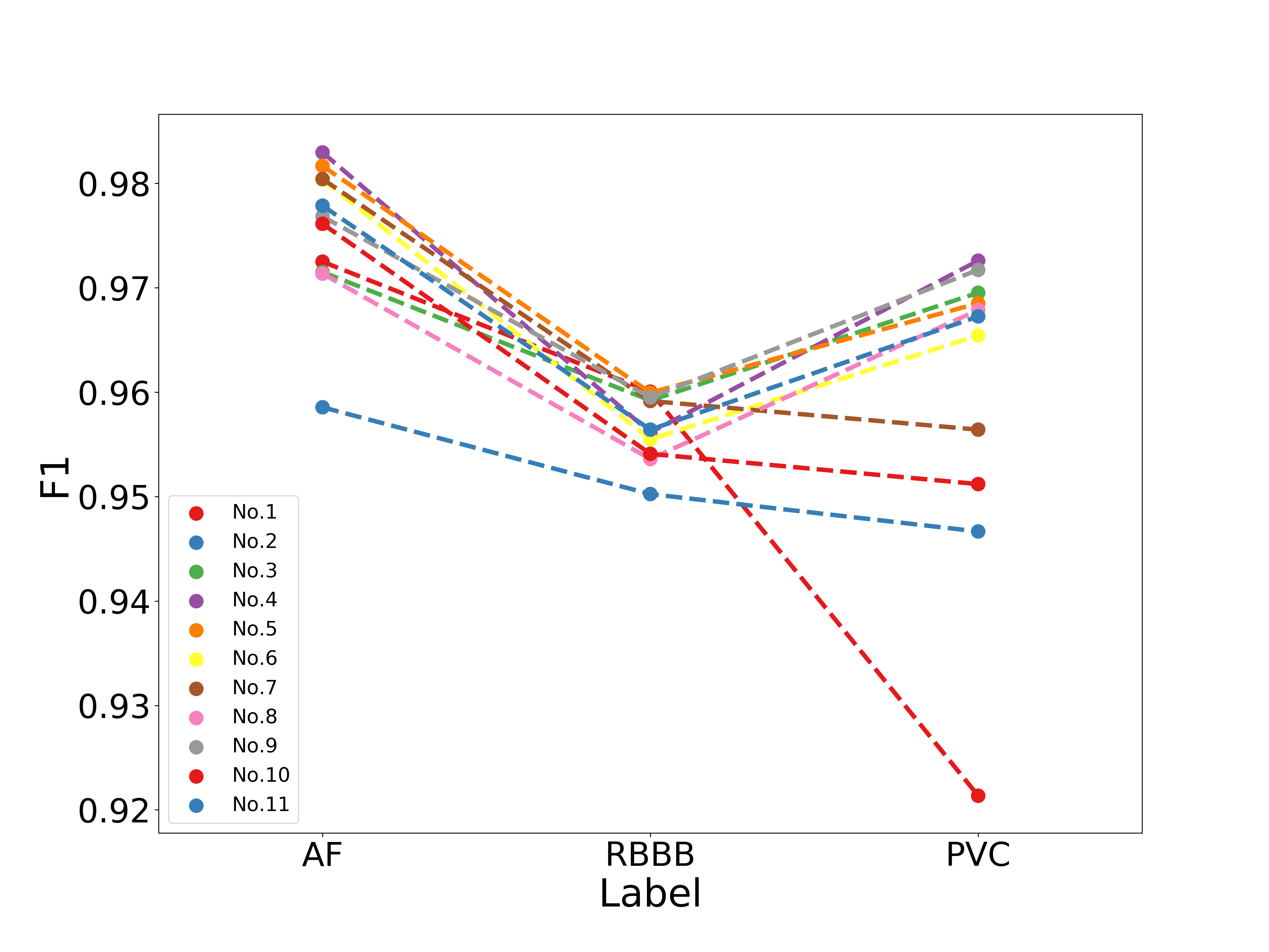 AF_RBBB_PVC