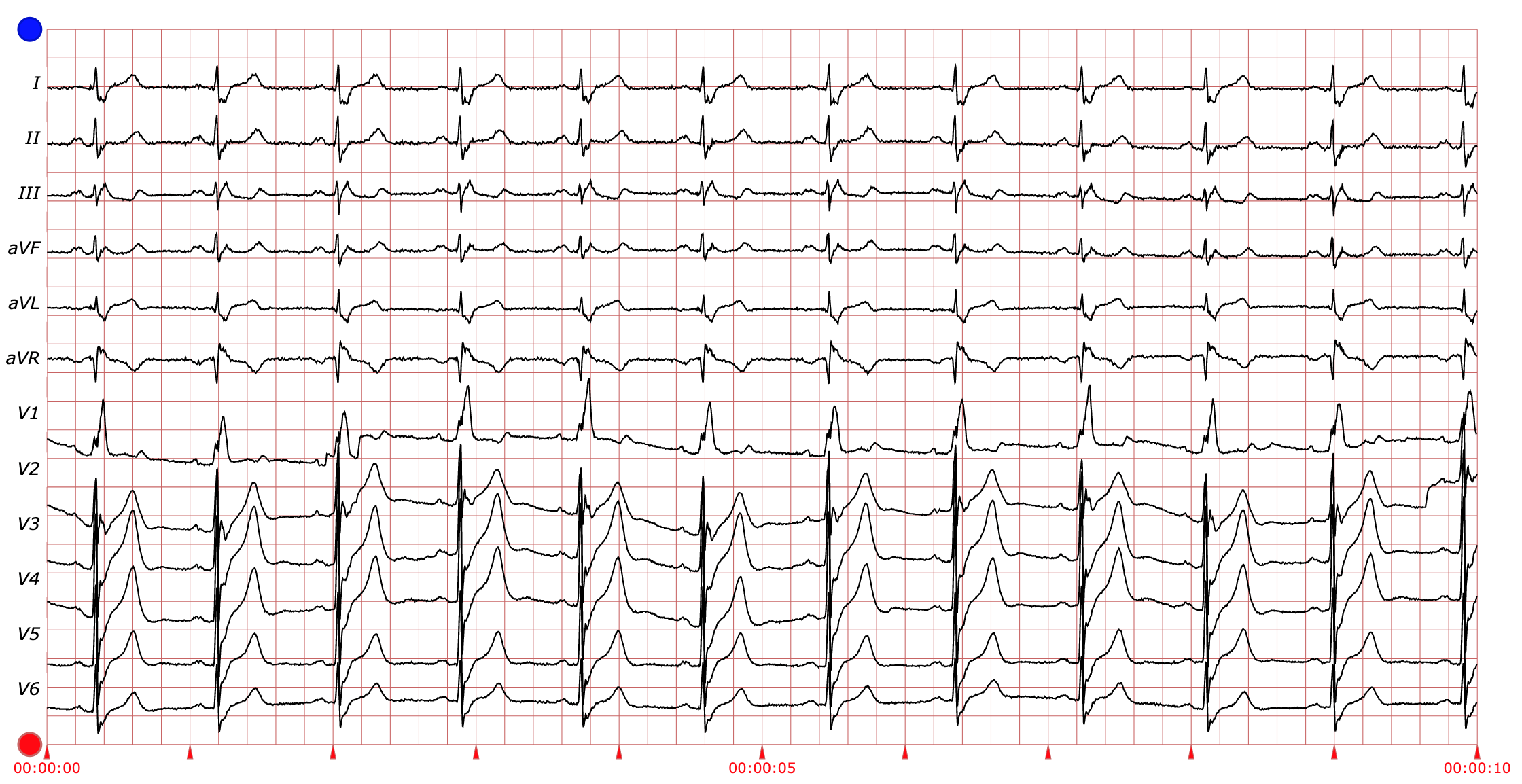 RBBB
